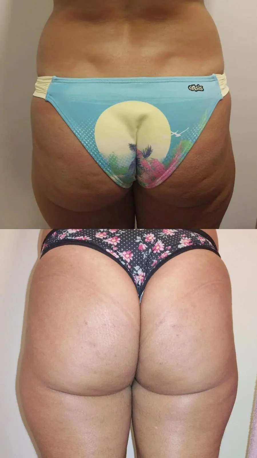 Tratamento para celulite